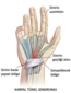 El Bileğinde Sinir Sıkışması Belirtileri ve Tedavisi