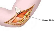 Ulnar Sinir Sıkışması Tedavisi